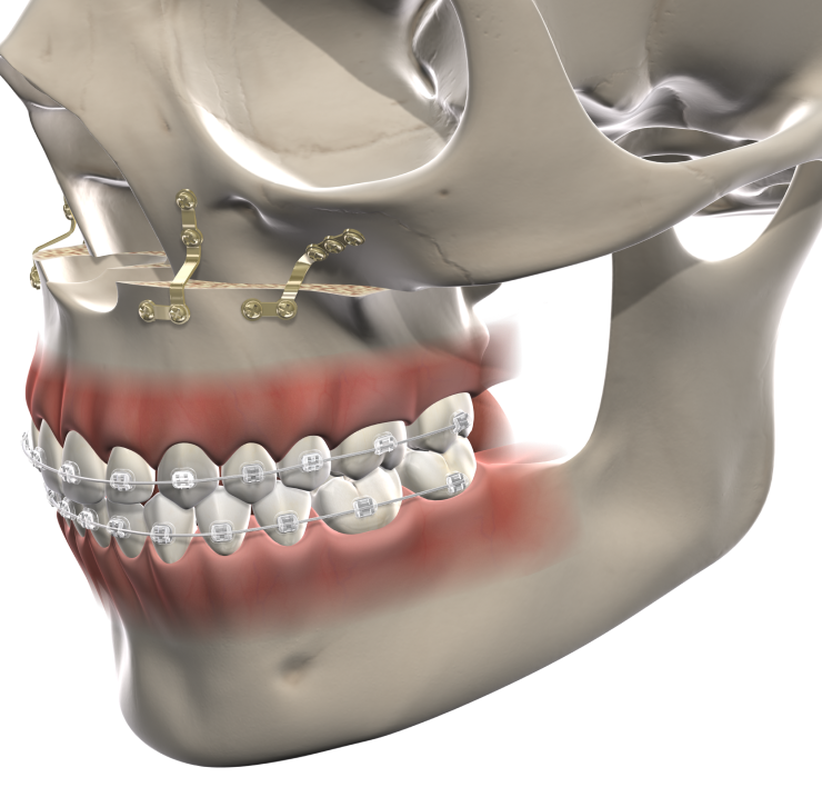 Isolated  facial trauma  mobile