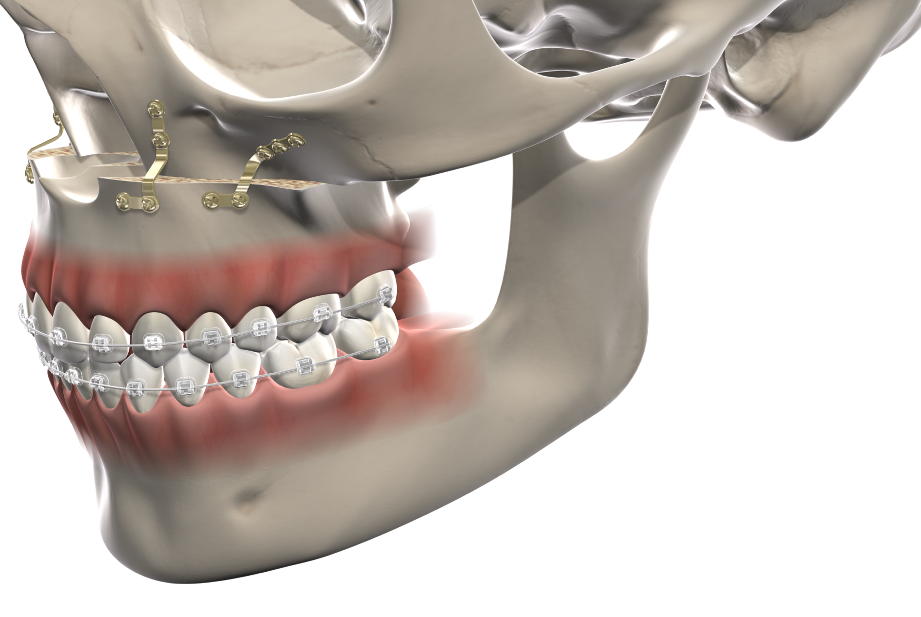 Isolated  facial trauma