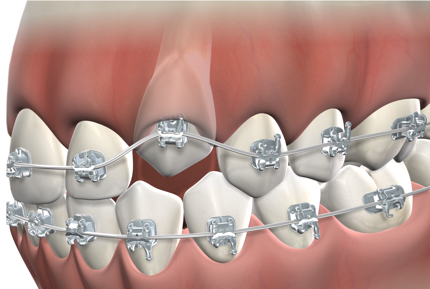 Isolated  impacted tooth