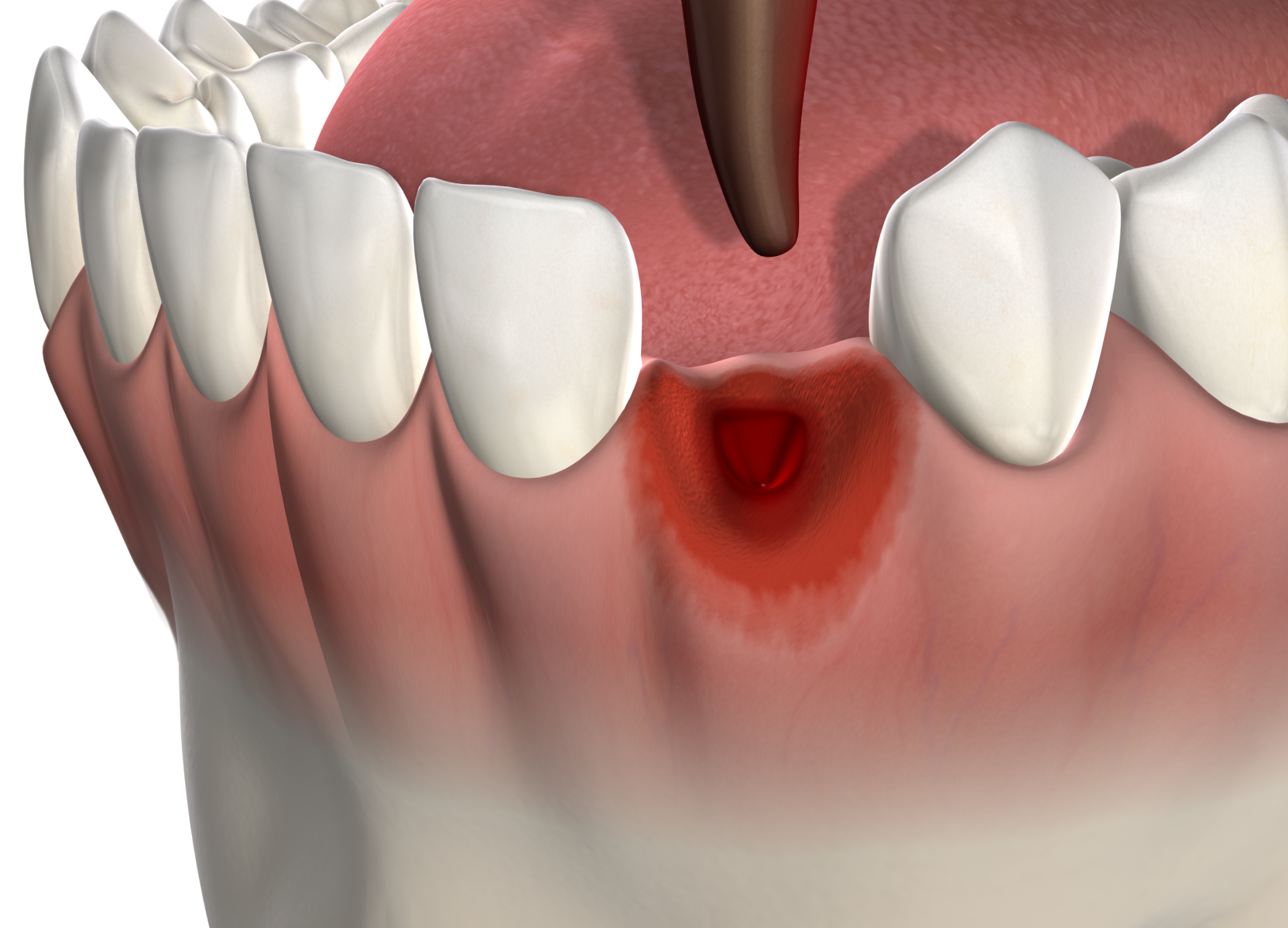 Isolated  tooth extractions