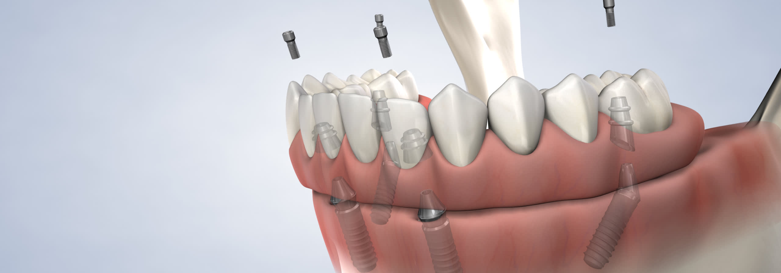 procedure  full arch restoration  desktop